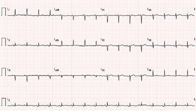 Efficacy and safety of anakinra in radiation-induced acute pericarditis: a case report